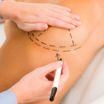 breast lift surgery