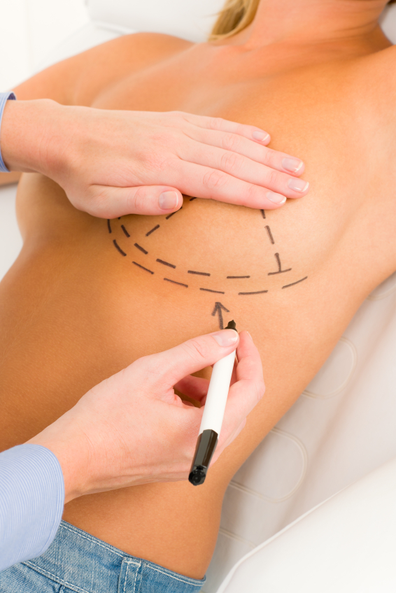 breast lift surgery